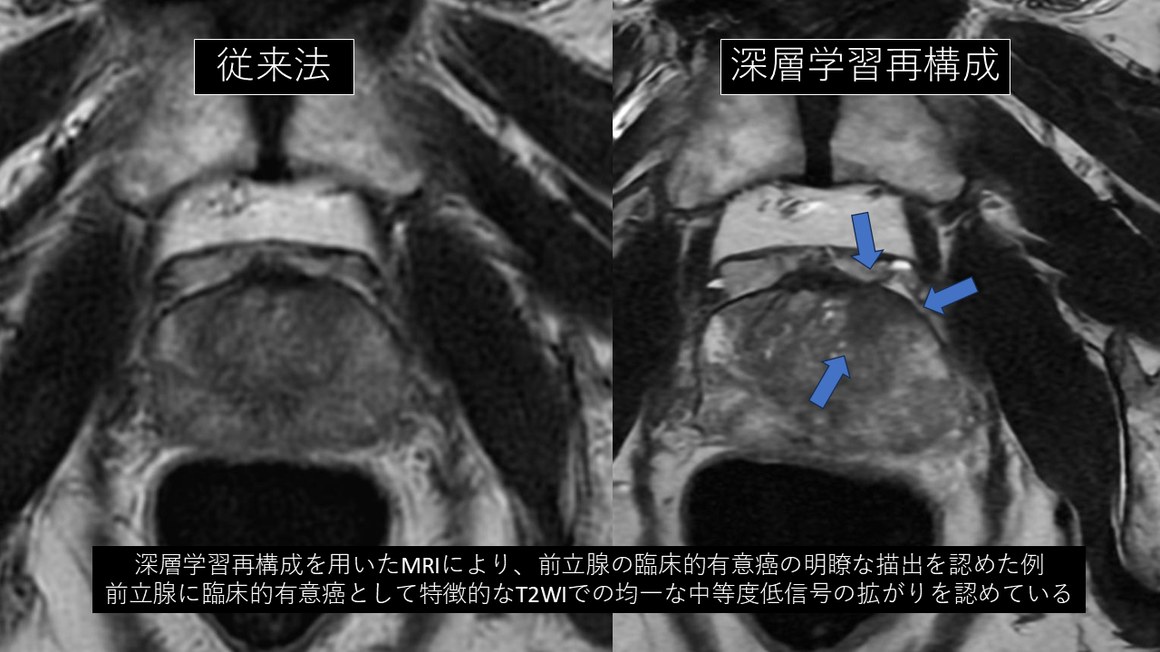 深層学習再構成による前立腺MRI（従来法との比較）